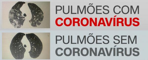 Imagens captadas em tomografia de tórax mostram a evolução do Covid-19 nos pulmões de uma mulher com mais de 70 anos (Foto: Reprodução/CNN)