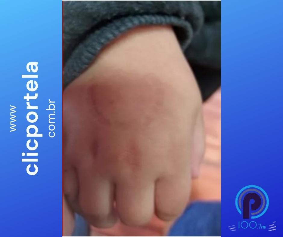Criança teve a mão mordida pela diretora da escola (Foto: Divulgação)