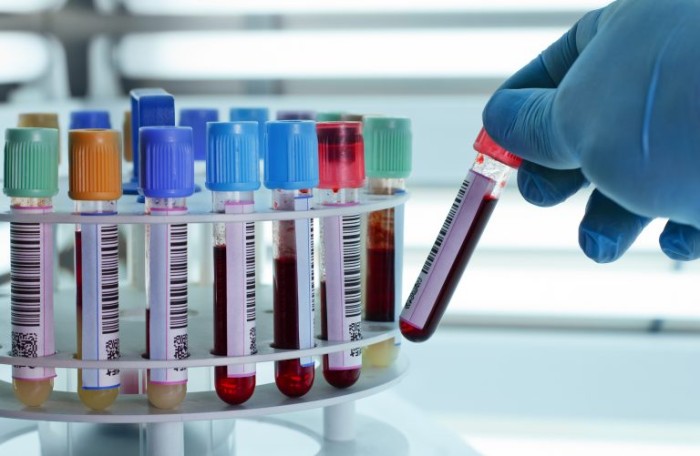 Diagnóstico é feito por meio de exames de sangue, urina e biópsia da medula óssea - (Foto: Depositphotos)